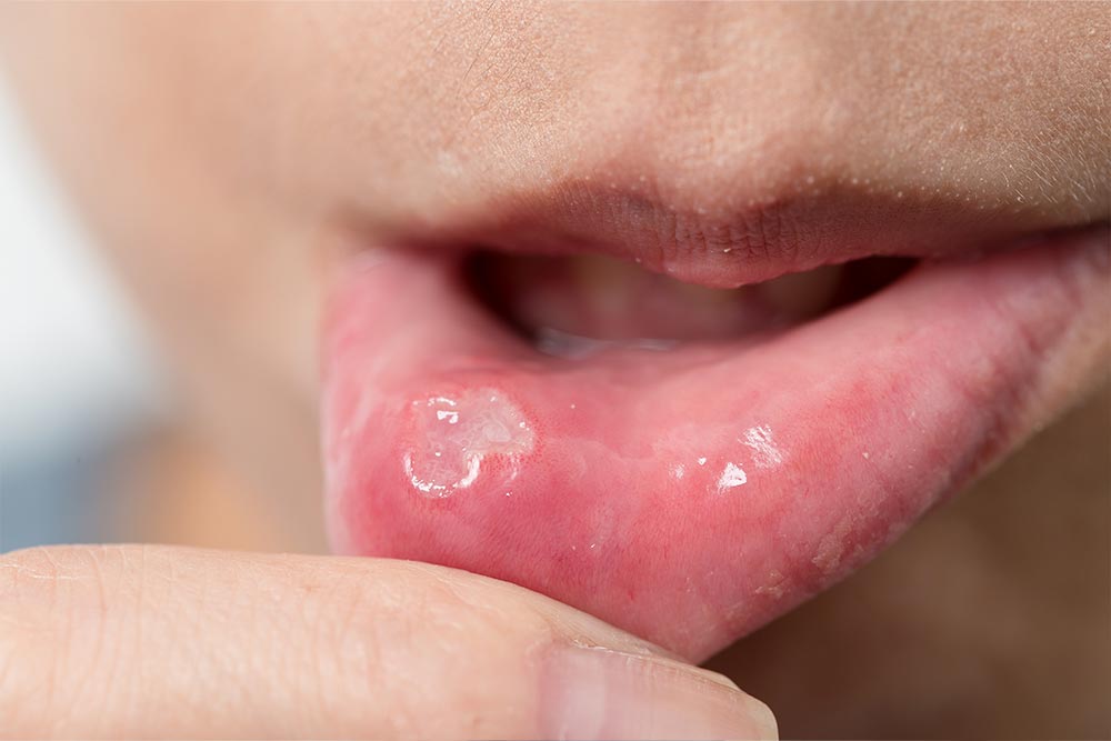Afta jako przeciwwskazanie do wizyty u dentysty Afta jako przeciwwskazanie do wizyty u dentysty
